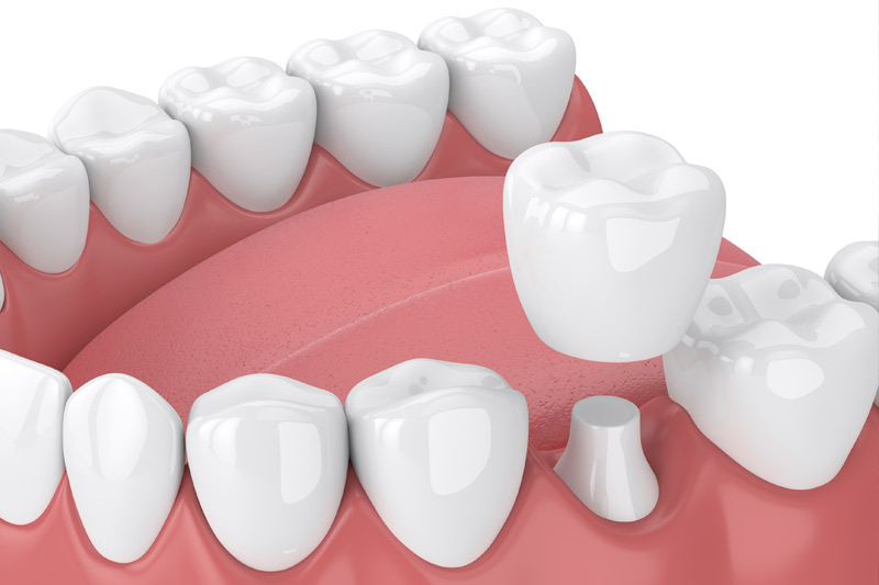 Dental Crowns in Chandler