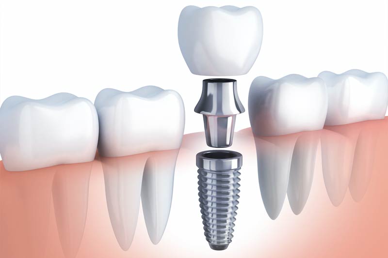 Implants Dentist in Chandler