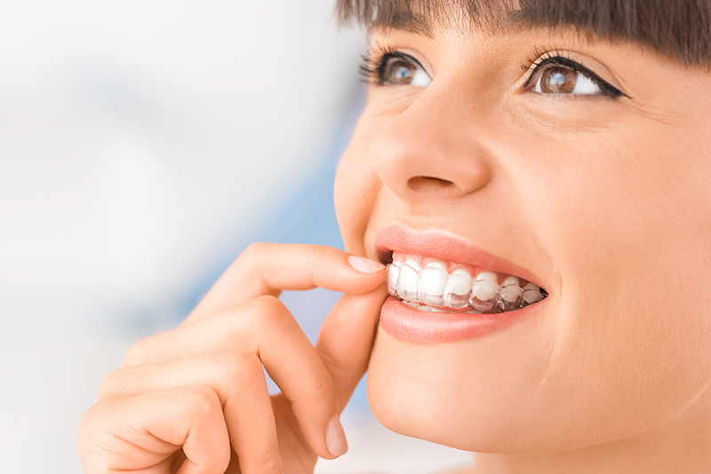 Invisalign in Chandler