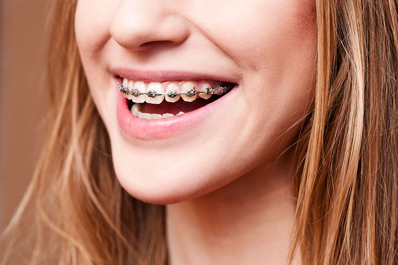 Orthodontics in Chandler