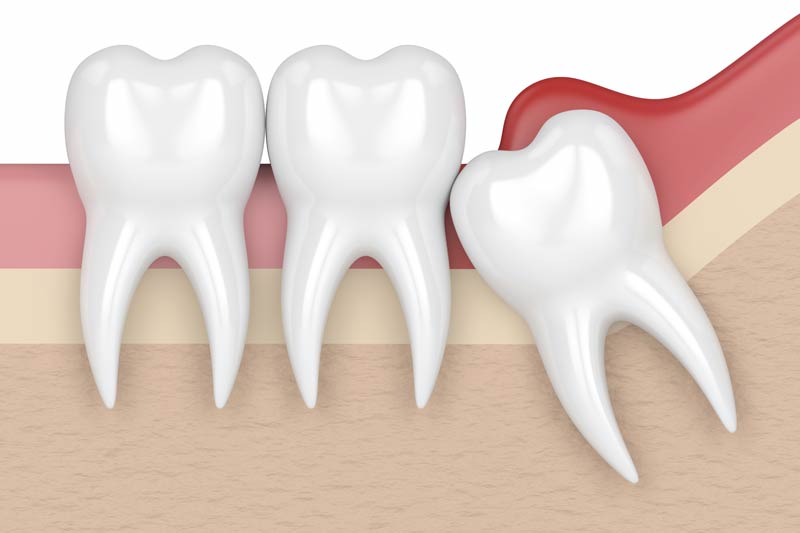 Wisdom Tooth Removal in Chandler